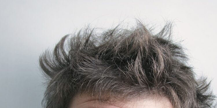 Top treatments for Hair Loss